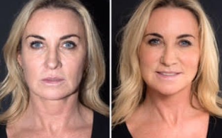Best Plastic Surgeons in Dubai: The Benefits of Thread Lift for Non-Surgical Facelifts