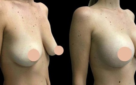 Personalized Options for Breast Augmentation Surgery in Dubai