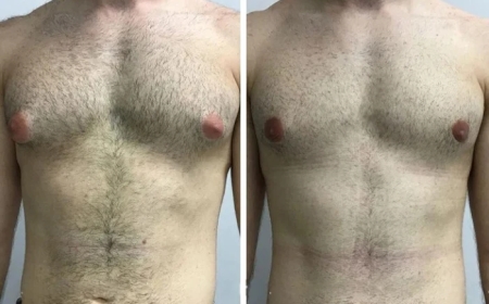 Post-Surgery Care Advice from the Best Gynecomastia Surgeons in Dubai