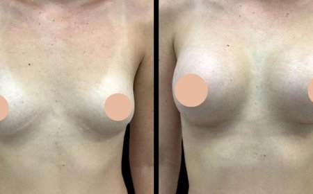 Breast Augmentation in Dubai: Exploring the Latest Trends and Techniques