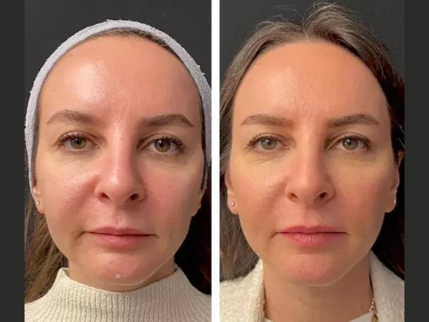 Combining Mesotherapy with Other Aesthetic Treatments: Tips from the Best Plastic Surgeons in Dubai