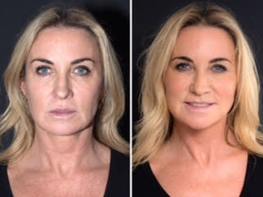 Best Plastic Surgeons in Dubai: The Benefits of Thread Lift for Non-Surgical Facelifts