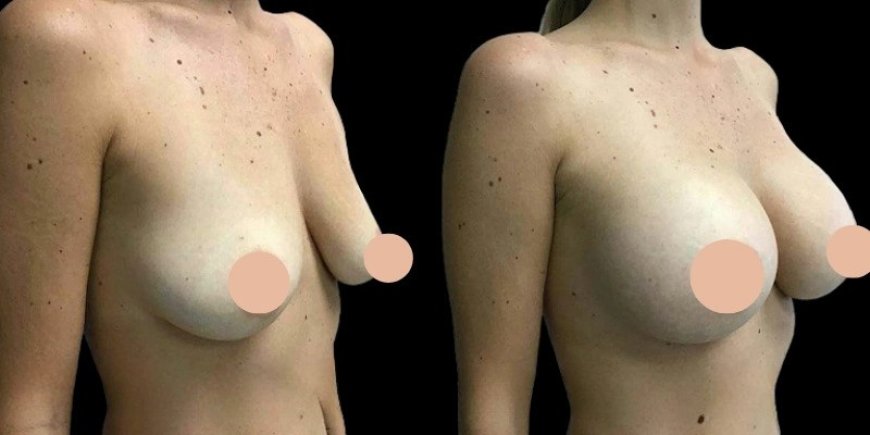 Personalized Options for Breast Augmentation Surgery in Dubai
