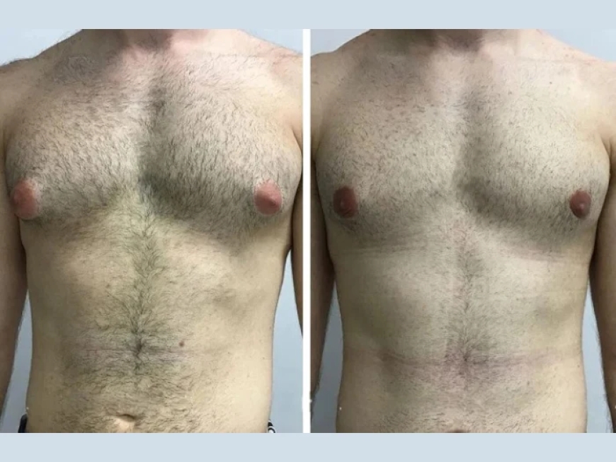 Is It Worth It? A Deep Dive with the Best Gynecomastia Surgeon in Dubai