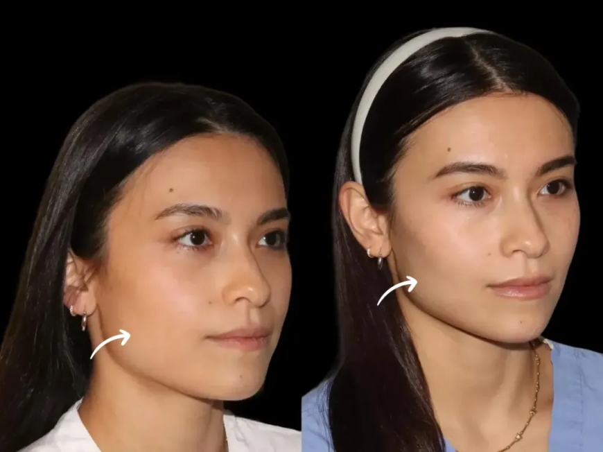 Viral Moments from Dubai’s Best Plastic Surgeon Using Sculptra Fillers