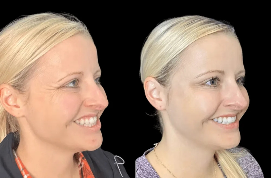 The Role of Technology in Enhancing Botox Treatment in Dubai