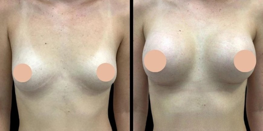Breast Augmentation in Dubai: Exploring the Latest Trends and Techniques
