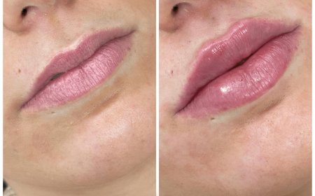 What to Do Before and After Your Dermal Filler Treatment at the Best Aesthetic Clinic in Dubai
