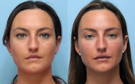 How Thread Lift Treatment in Dubai Enhances Facial Contours