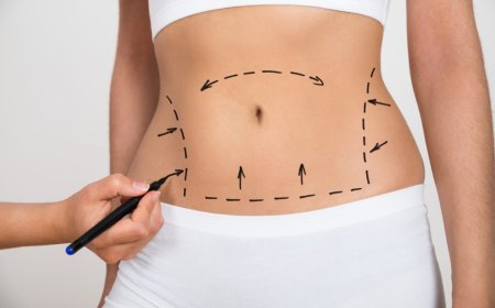 Liposuction Wellness Tips By Best Liposuction Surgeon in Dubai