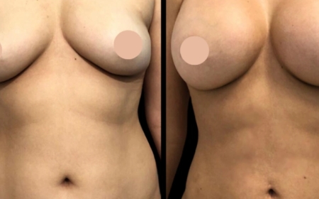 The Life-Changing Work of the Best Breast Augmentation Surgeon in Dubai