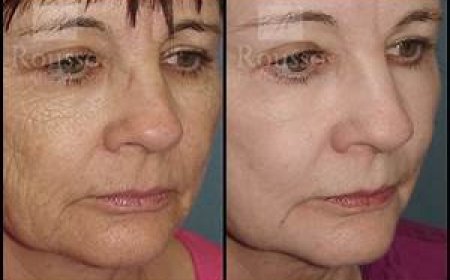 Understanding Chemical Peel Before and After Results: A Complete Guide