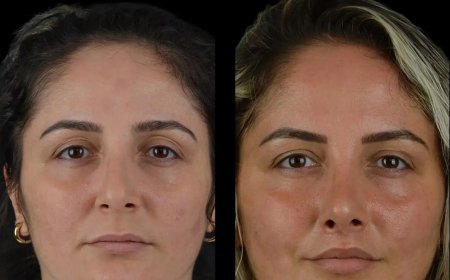 How Cheek Fillers in Dubai Can Transform Your Look Without Surgery