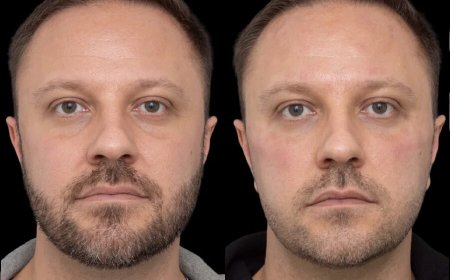 How Long Does It Take to Recover After Under Eye Fillers in Dubai?