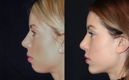 Best Aesthetic Clinics in dubai for Chin Fillers: What to Know About Cost and Pricing