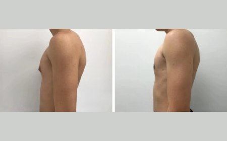 How to Prepare for Your First Consultation with the Best Gynecomastia Surgeon in Dubai