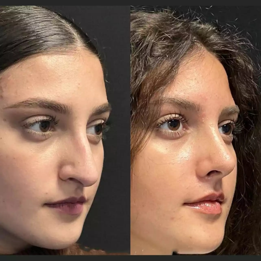Is Rhinoplasty in Dubai Covered by Insurance?
