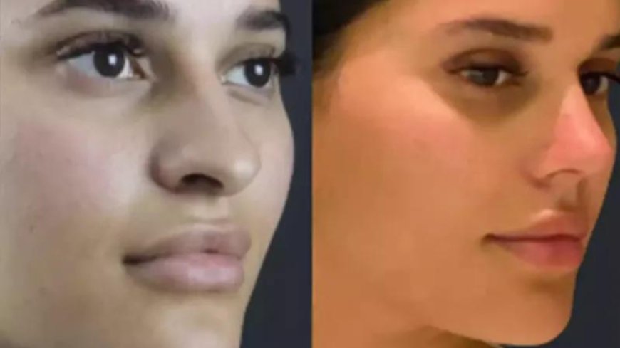 Septoplasty in Dubai for Deviated Septum Correction