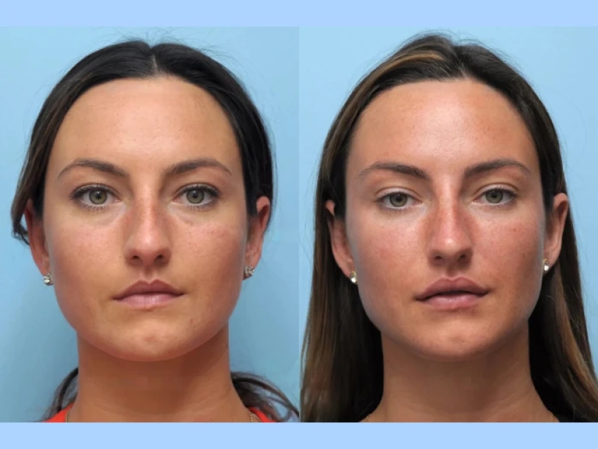 Why the Best Aesthetic Clinic in Dubai Is Ideal for Thread Lift Procedures