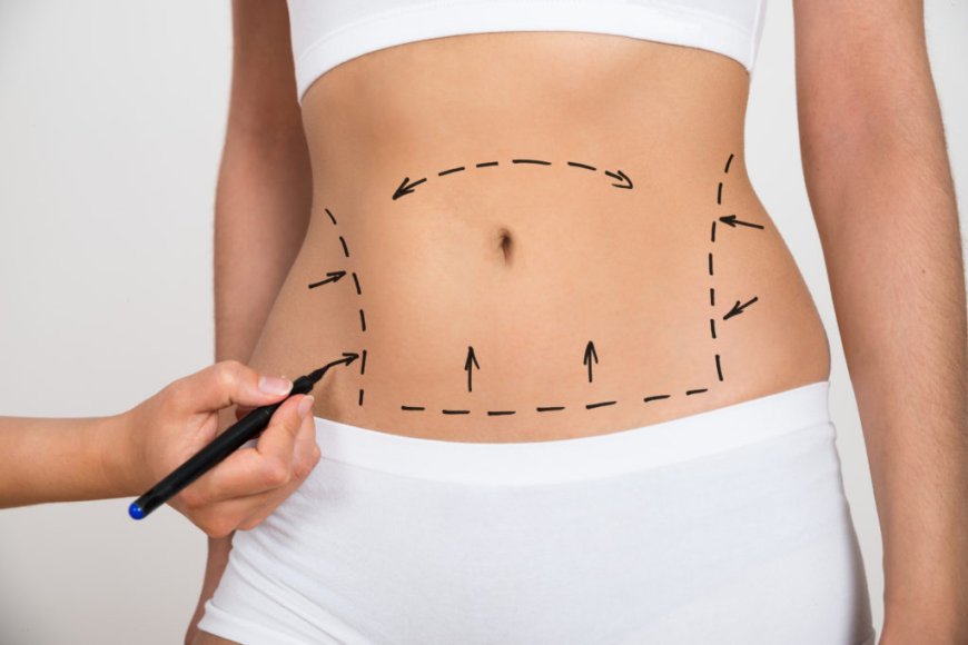 Liposuction Wellness Tips By Best Liposuction Surgeon in Dubai