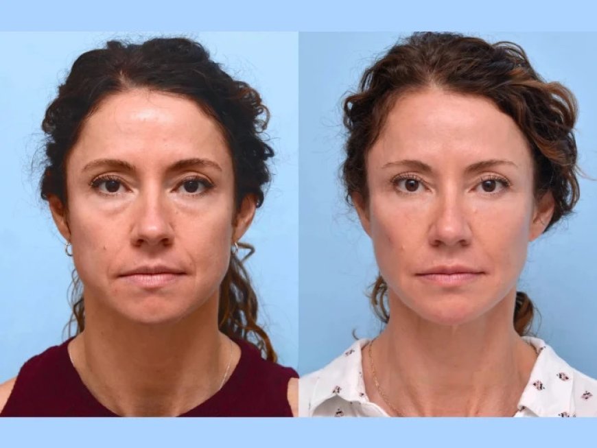 Age Gracefully: Best Aesthetic Clinics in Dubai for Thread Lift Procedures