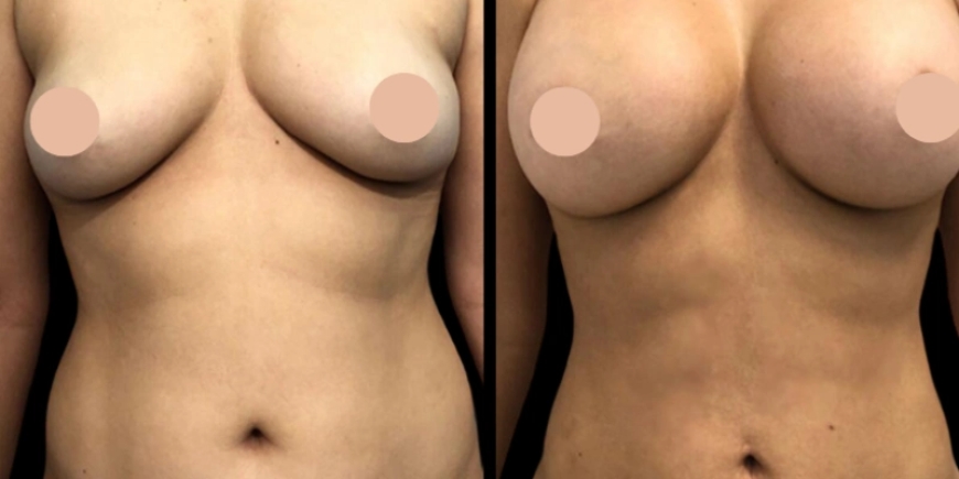 The Life-Changing Work of the Best Breast Augmentation Surgeon in Dubai