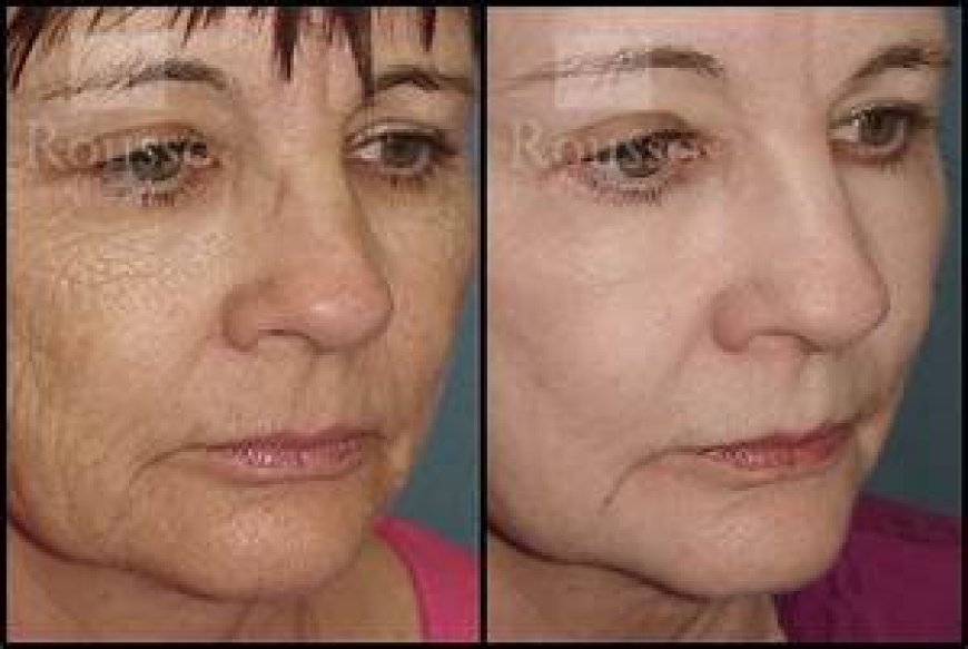 Understanding Chemical Peel Before and After Results: A Complete Guide