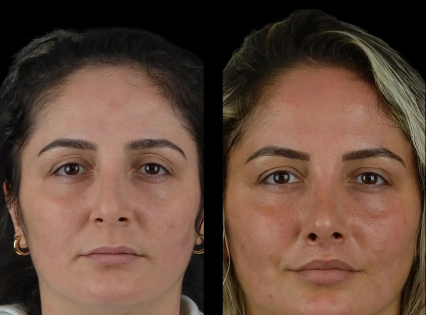 How Cheek Fillers in Dubai Can Transform Your Look Without Surgery