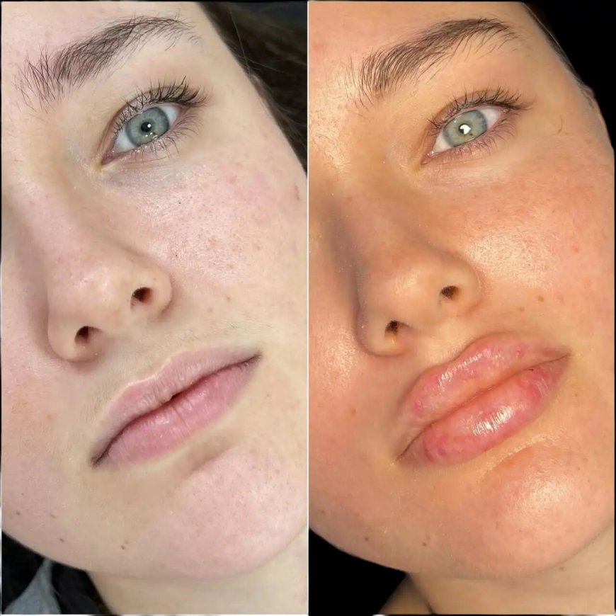 Achieve Subtle Enhancements with Dermal Fillers in Dubai