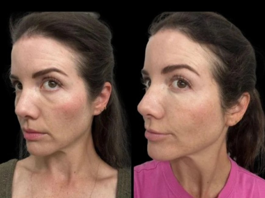 How to Maintain Your Results After Dark Circles Treatment in Dubai