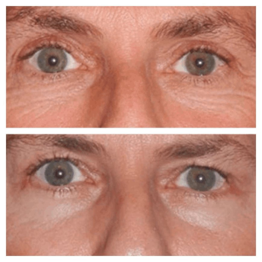 How to Prepare Your Home for Recovery Following Surgery by the Best Eye bag removal Surgeons in Dubai