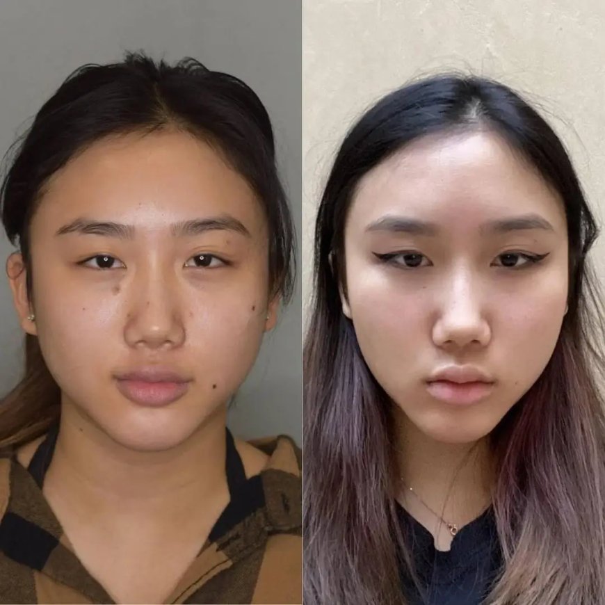 Top 10 Questions Answered by the Best Buccal fat removal Surgeons in Dubai