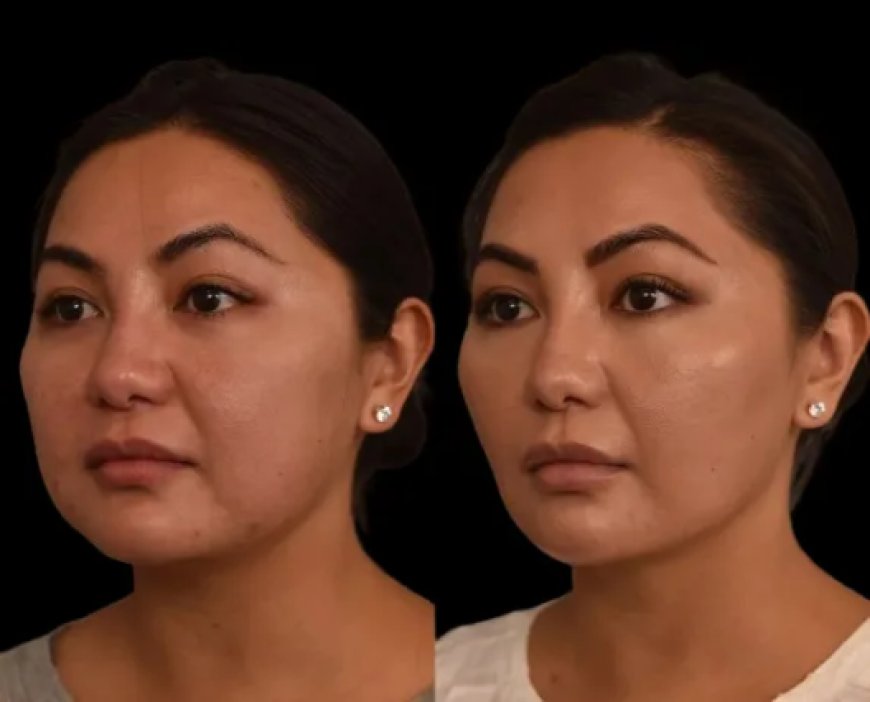 Best Double chin removal Surgeons in Dubai on Managing Expectations