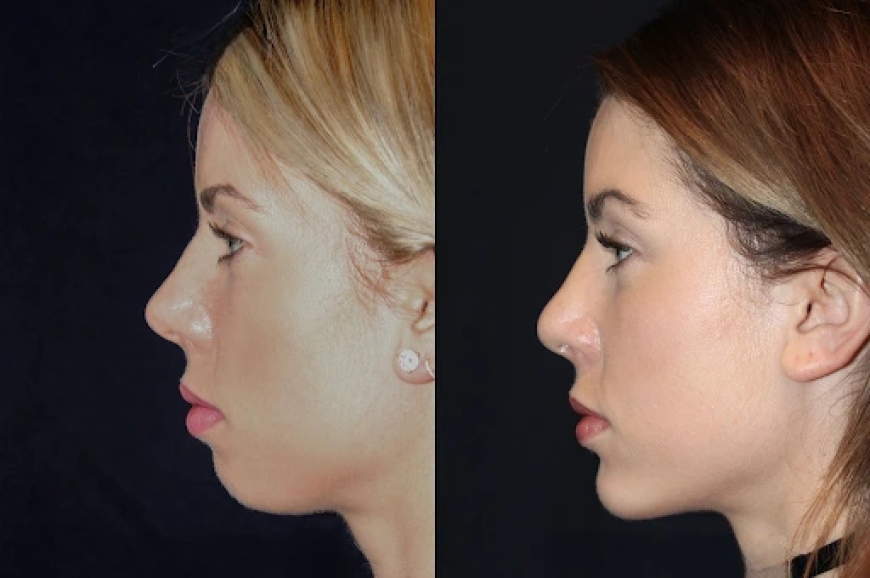 Best Aesthetic Clinics in dubai for Chin Fillers: What to Know About Cost and Pricing