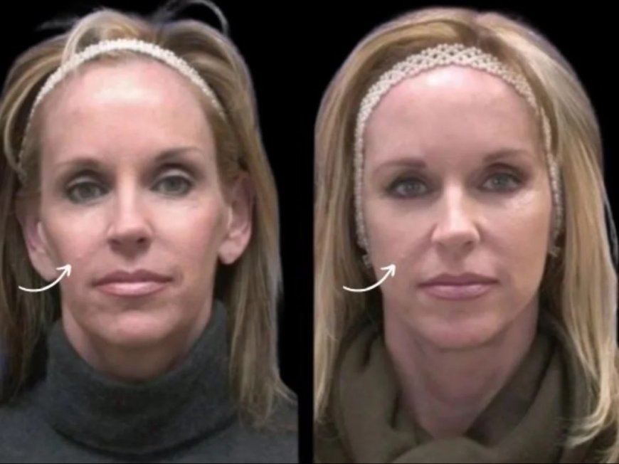 Cultivating Confidence: Best Plastic Surgeons in Dubai on Sculptra Fillers