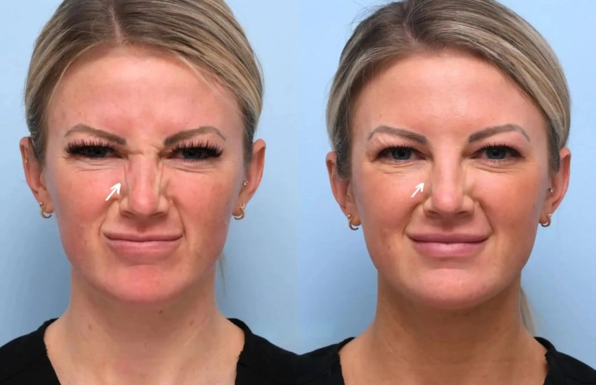 Experience the Benefits of Botox: Best Plastic Surgeons in Dubai for a Fresh, Refreshed Look
