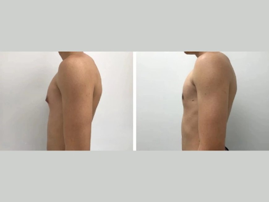 How to Prepare for Your First Consultation with the Best Gynecomastia Surgeon in Dubai