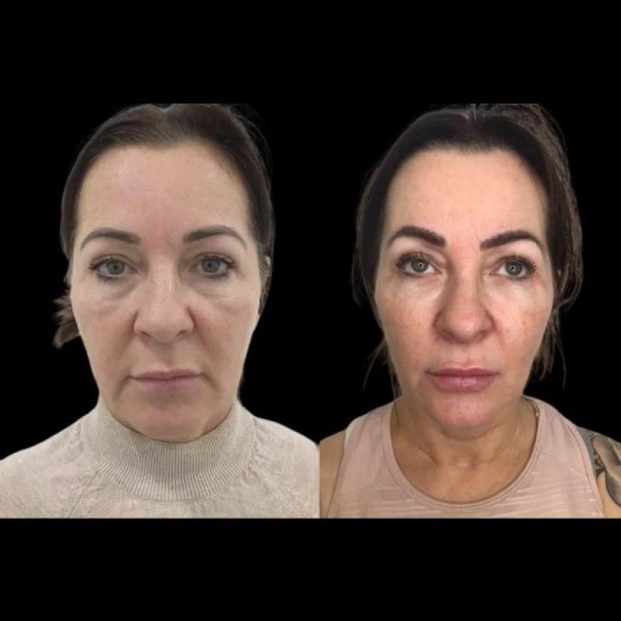 The Role of Profhilo in Anti-Aging: Leading Plastic Surgeon in Dubai Weigh In